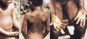 Rare Monkeypox Virus Is Spreading Again – Here’s What You Need To Know