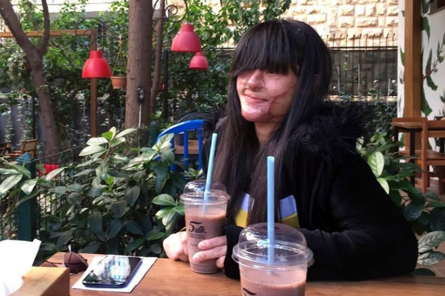 Boyfriend Throws Acid In Her Face In A Moment Of Rage But She Married